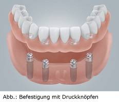 zahnimplantate_03