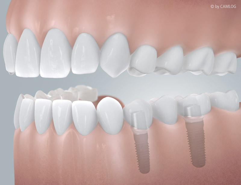 CAMLOG_Schaltluecke_mit_Implantatversorgung_c