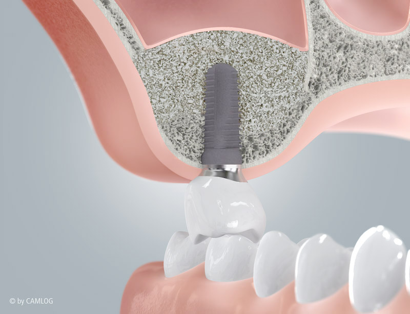 CAMLOG_Sinuslift_mit_Implantatversorgung_c