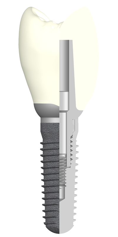 Schnitt Implantat-Abutment-Krone